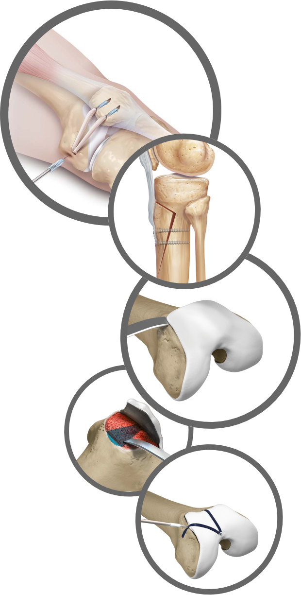 Kniescheibeninstabilität: MPFL-Ersatz, TT-Versatz, Trochleaplastik Kniescheibeninstabilität: MPFL-Ersatz, TT-Versatz, Trochleaplastik